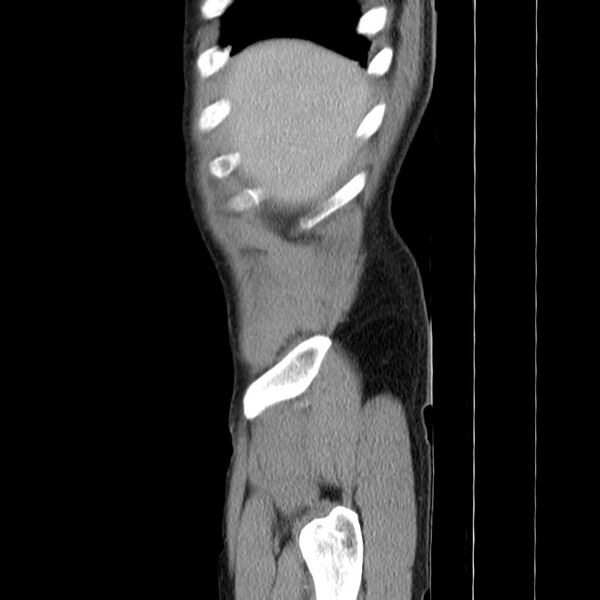 File:Acute pancreatitis (Radiopaedia 22572-22596 Sagittal C+ portal venous phase 6).jpg