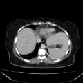 Acute pancreatitis - Balthazar C (Radiopaedia 26569-26714 Axial C+ portal venous phase 20).jpg