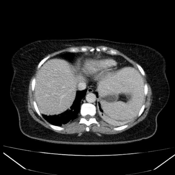 File:Acute pancreatitis - Balthazar C (Radiopaedia 26569-26714 Axial C+ portal venous phase 20).jpg