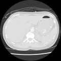 Acute pulmonary edema on CT (Radiopaedia 33582-34672 Axial lung window 54).jpg