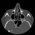 Acute sinusitis (Radiopaedia 23161-23215 Axial bone window 34).jpg