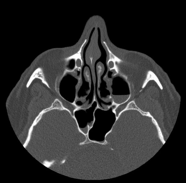 File:Acute sinusitis (Radiopaedia 23161-23215 Axial bone window 34).jpg