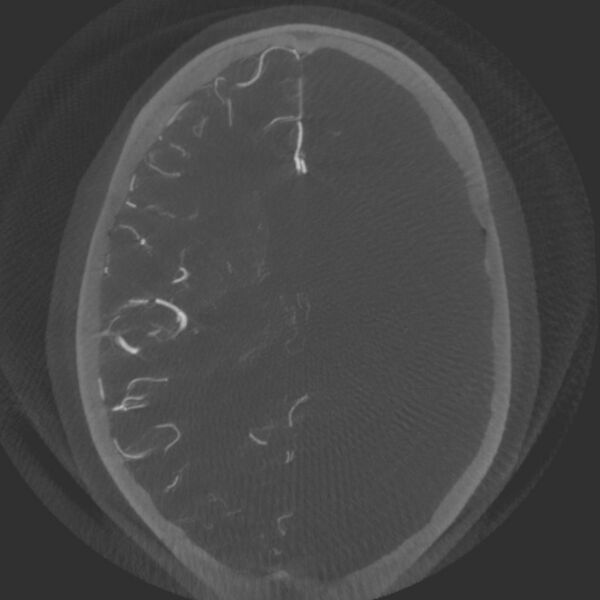 File:Acute subarachnoid hemorrhage and accessory anterior cerebral artery (Radiopaedia 69231-79010 Axial arterial - MIP 48).jpg