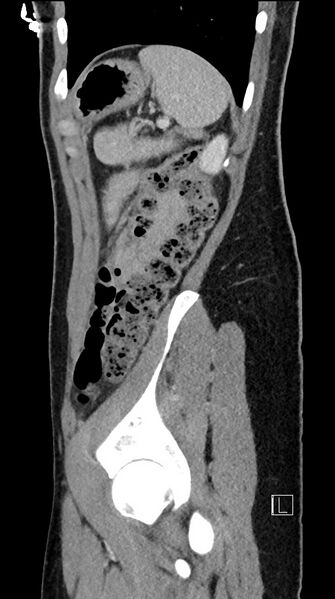 File:Acute uncomplicated appendicitis (Radiopaedia 61374-69304 Sagittal C+ portal venous phase 21).jpg