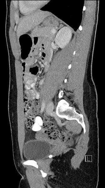 File:Acute uncomplicated appendicitis (Radiopaedia 61374-69304 Sagittal C+ portal venous phase 40).jpg