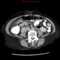Adenocarcinoma of the colon (Radiopaedia 8191-9039 Axial renal excretory phase 30).jpg