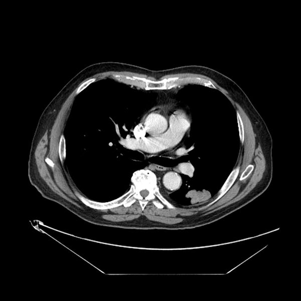 File:Adenocarcinoma of the lung (Radiopaedia 44876-48759 Axial C+ portal venous phase 39).jpg