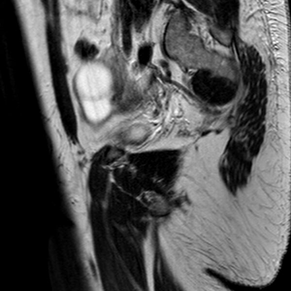 File:Adenomyoma of the uterus (Radiopaedia 9871-10439 Sagittal T2 6).jpg