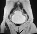 Adenomyosis - ovarian endometriomas (Radiopaedia 67031-76350 Coronal T2 3).jpg