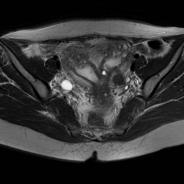 File:Adenomyosis within a septate uterus (Radiopaedia 69963-79981 Axial T2 17).jpg