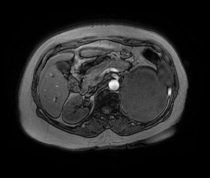 File:Adrenal cortical carcinoma (Radiopaedia 70906-81116 Axial T1 in-phase-out-of-phase 17).jpg
