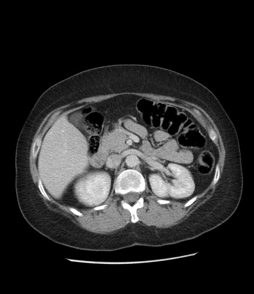 File:Adrenal cortical carcinoma with IVC invasion and thrombosis (Radiopaedia 34307-35597 Axial C+ portal venous phase 32).jpg