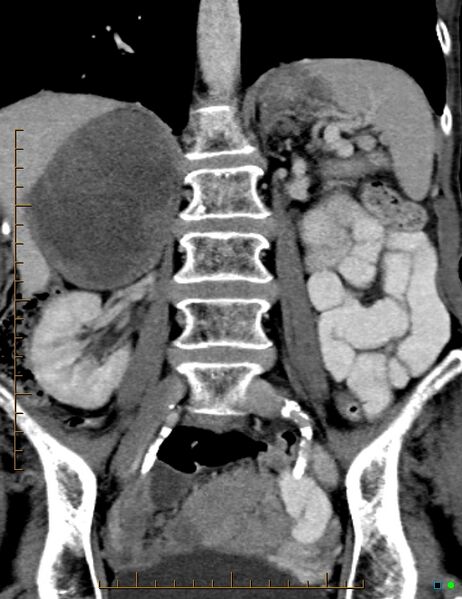 File:Adrenal metastasis from small cell lung cancer (Radiopaedia 19133-19108 Coronal C+ portal venous phase 1).jpg
