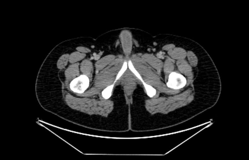 File:Adrenocortical carcinoma (Radiopaedia 80134-93438 Axial C+ portal venous phase 140).jpg