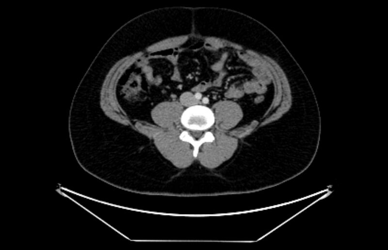 File:Adrenocortical carcinoma (Radiopaedia 80134-93438 Axial C+ portal venous phase 82).jpg