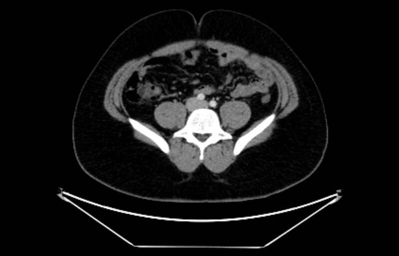 File:Adrenocortical carcinoma (Radiopaedia 80134-93438 Axial C+ portal venous phase 87).jpg