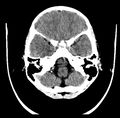 Adrenoleukodystrophy (Radiopaedia 10580-11038 Axial non-contrast 1).jpg