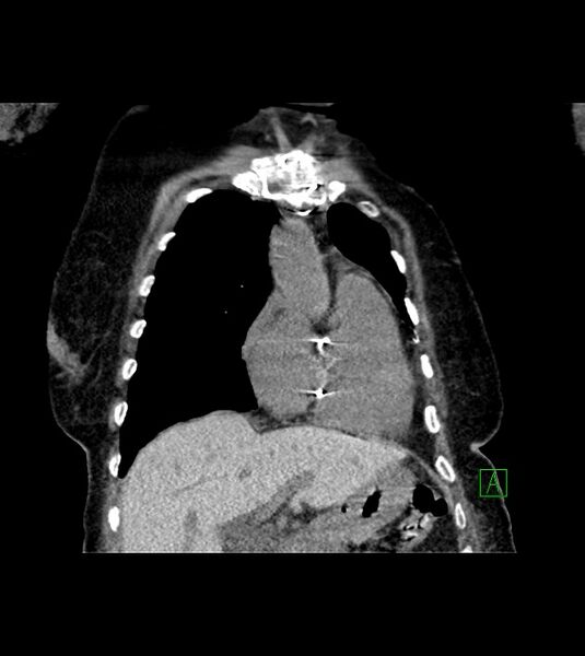 File:Amiodarone deposition in the liver (Radiopaedia 77587-89780 Coronal non-contrast 25).jpg