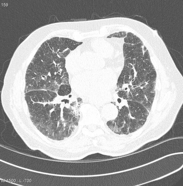 File:Amiodarone lung (Radiopaedia 6539-7851 Axial lung window 16).jpg