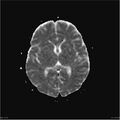 Amnestic syndrome secondary to hypoxic brain injury (Radiopaedia 24743-25004 ADC 17).jpg