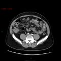 Ampullary carcinoma (Radiopaedia 56396-63056 B 50).jpg