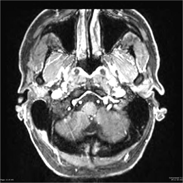 File:Anaplastic meningioma with recurrence (Radiopaedia 34452-35788 Axial T1 C+ 11).jpg