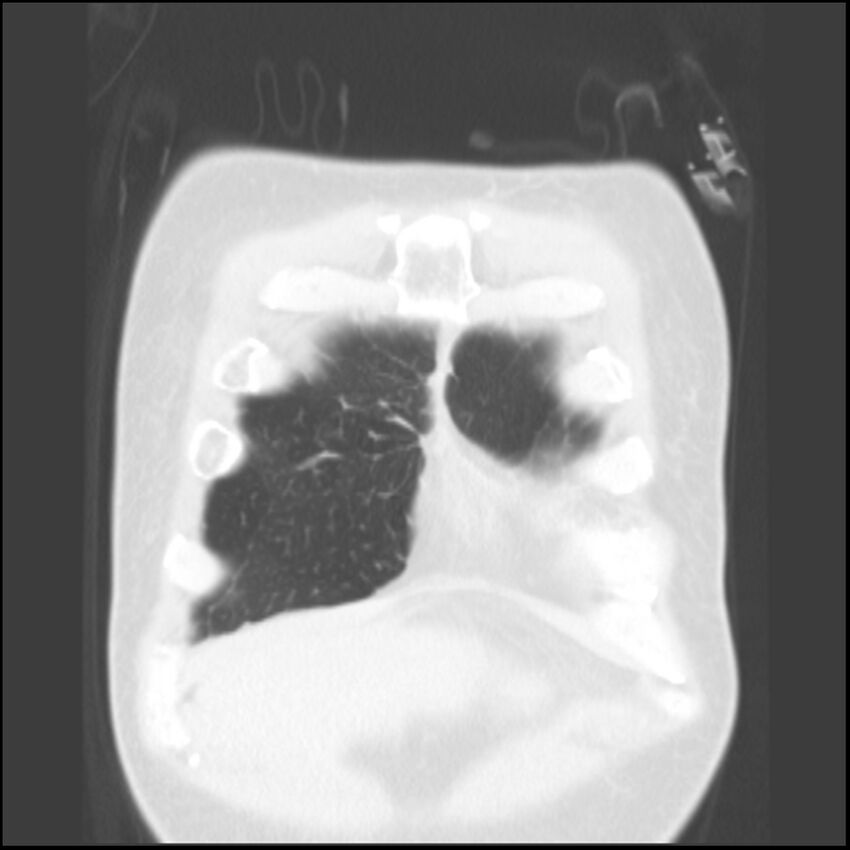 Angioinvasive aspergillosis (Radiopaedia 43957-47466 Coronal lung window 83).jpg