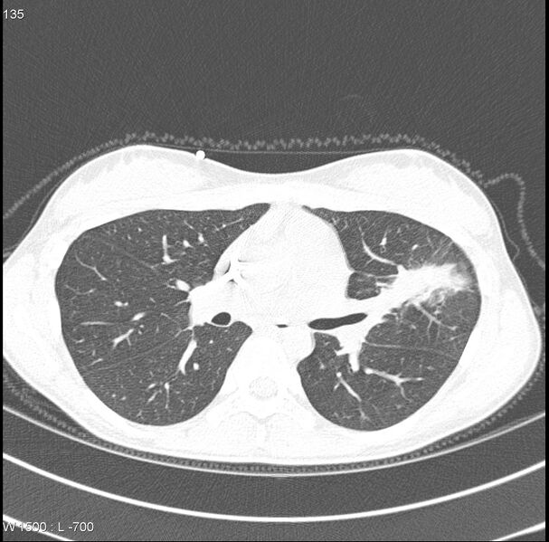 File:Angioinvasive aspergillosis (Radiopaedia 8651-15074 Axial lung window 3).jpg