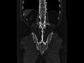 Ankylosing spondylitis (Radiopaedia 44609-48357 Coronal bone window 83).jpg