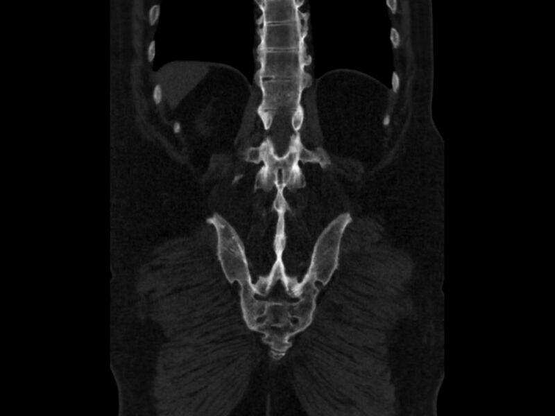 File:Ankylosing spondylitis (Radiopaedia 44609-48357 Coronal bone window 83).jpg