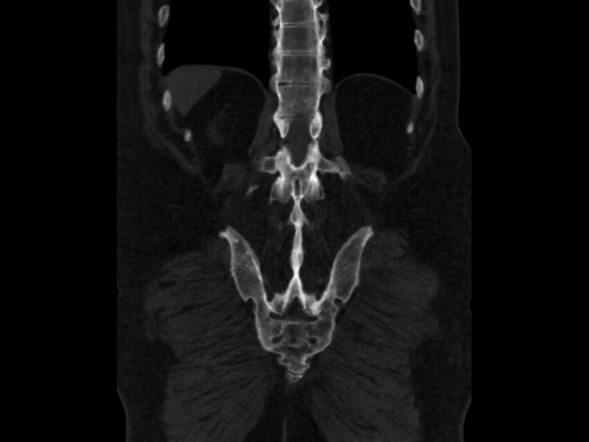 Ankylosing spondylitis (Radiopaedia 44609-48357 Coronal bone window 83).jpg
