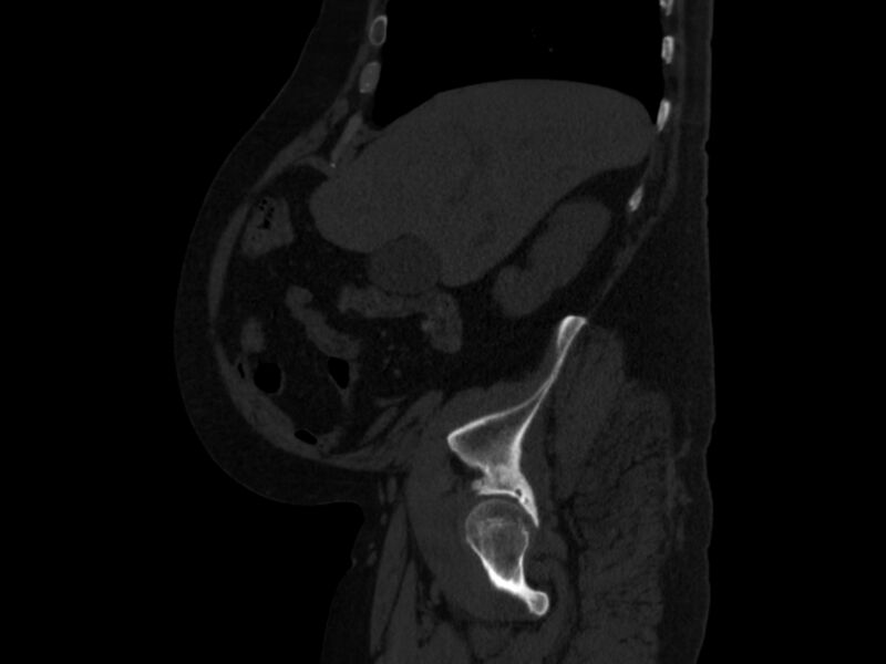 File:Ankylosing spondylitis (Radiopaedia 44609-48357 Sagittal bone window 17).jpg