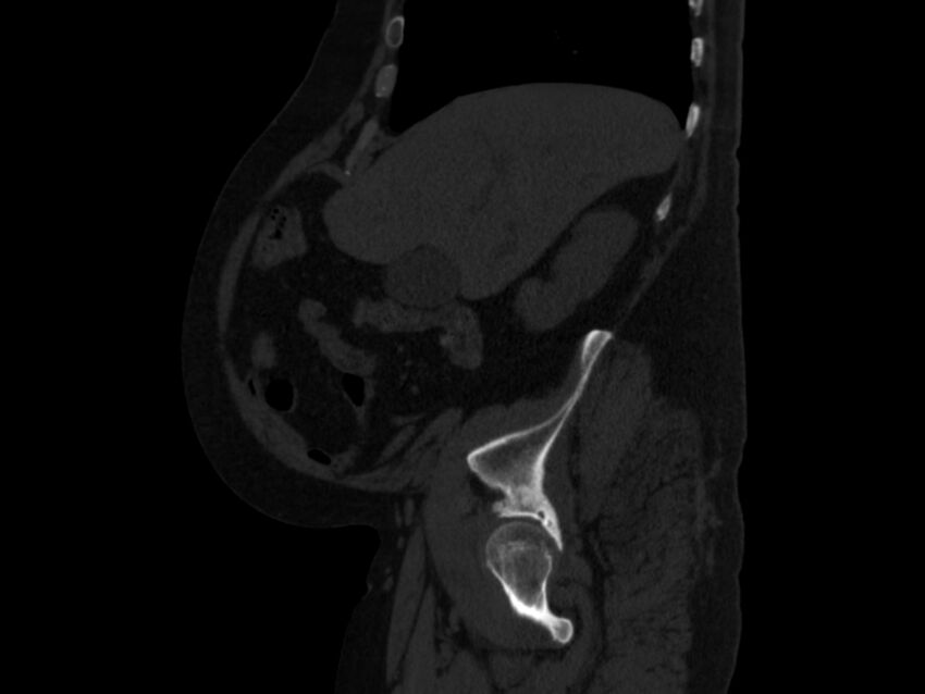 Ankylosing spondylitis (Radiopaedia 44609-48357 Sagittal bone window 17).jpg
