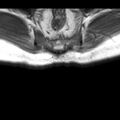 Ankylosing spondylitis with zygapophyseal arthritis (Radiopaedia 38433-40517 B 18).jpg