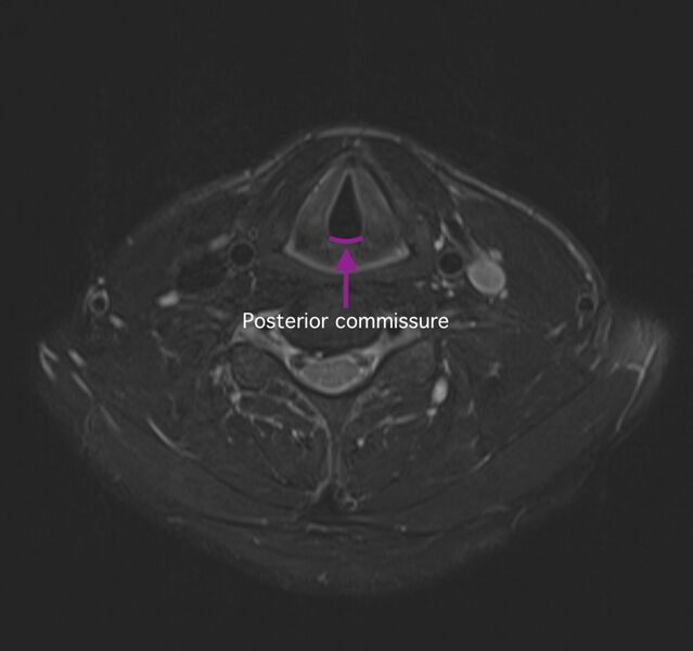 File:Anterior and posterior commissures of the larynx (diagrams) (Radiopaedia 61209-69116 B 1).jpg