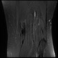 Anterior cruciate ligament tear, Wrisberg rip and bucket-handle tear of medial meniscus (Radiopaedia 75872-87266 Coronal PD fat sat 23).jpg