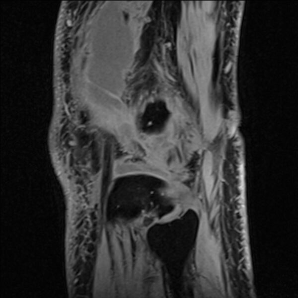 File:Anterior cruciate ligament tear - ramp lesion (Radiopaedia 71883-82322 Sagittal T1 vibe 22).jpg