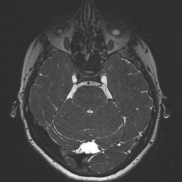 File:Anterior temporal encephalocele (Radiopaedia 82624-96808 Axial T2 high res 49).jpg