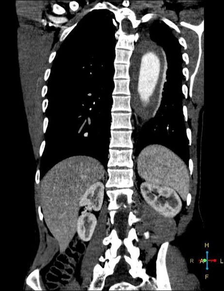 File:Aortic aneurysm and penetrating ulcer (Radiopaedia 23590-23704 B 21).jpg