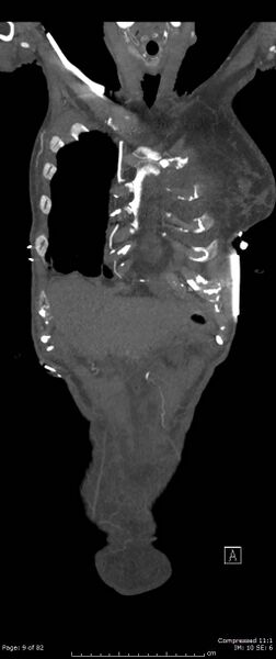File:Aortic dissection with extension into aortic arch branches (Radiopaedia 64402-73204 A 9).jpg