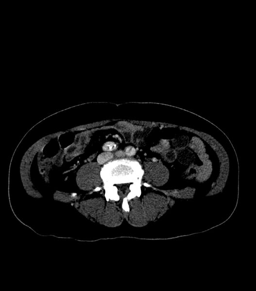 File:Aortic dissection with renal ischemia (Radiopaedia 76573-88338 B 48).jpg