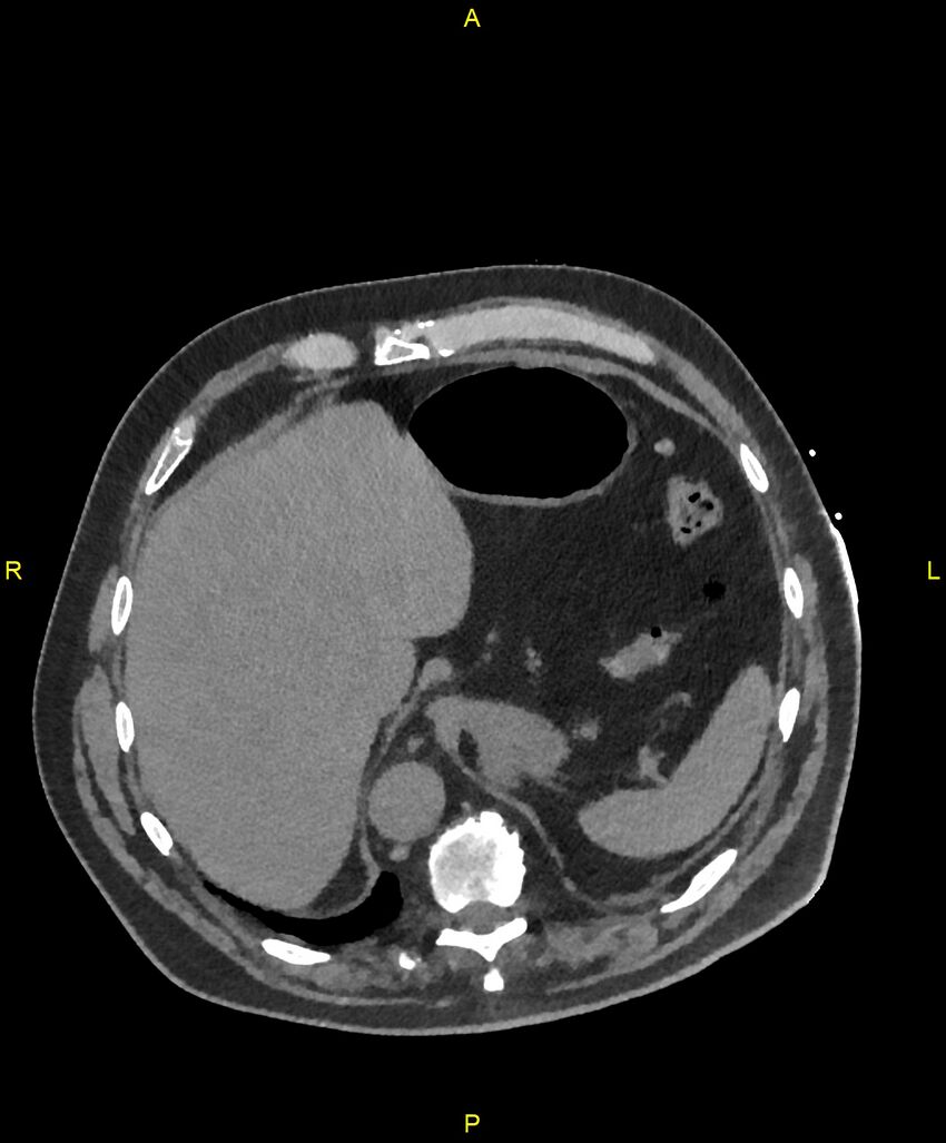 Aortic rupture (Radiopaedia 88822-105594 Axial non-contrast 214).jpg