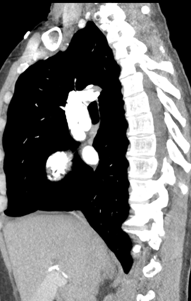 File:Aortic valve non-coronary cusp thrombus (Radiopaedia 55661-62189 C+ arterial phase 39).png