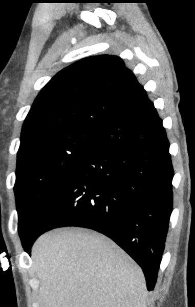 File:Aortic valve non-coronary cusp thrombus (Radiopaedia 55661-62189 C+ arterial phase 61).png