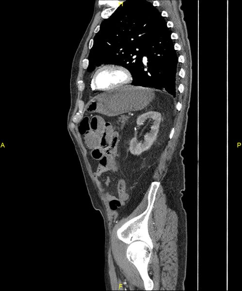 File:Aortoenteric fistula (Radiopaedia 84308-99603 C 254).jpg