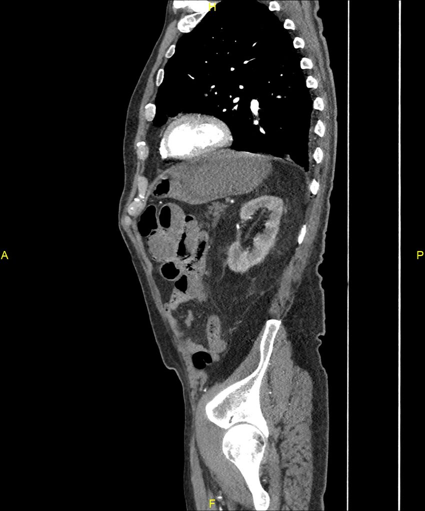 Aortoenteric fistula (Radiopaedia 84308-99603 C 254).jpg