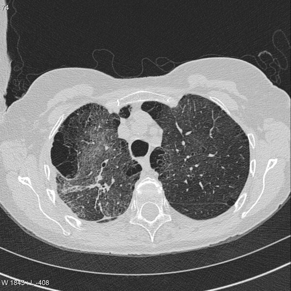 File:Apical non-small-cell lung cancer (Radiopaedia 8570-9405 Axial lung window 11).jpg