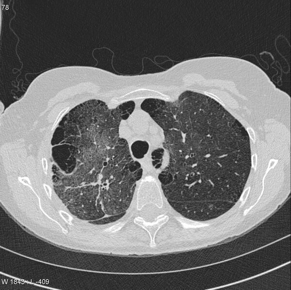 File:Apical non-small-cell lung cancer (Radiopaedia 8570-9405 Axial lung window 12).jpg
