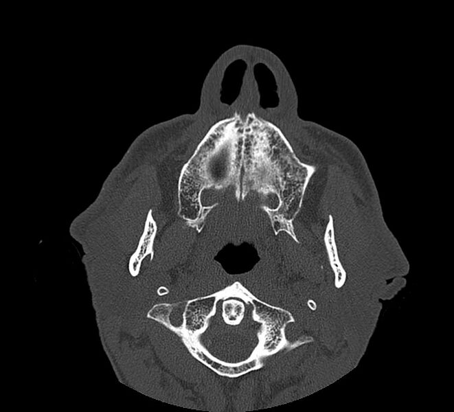 File:Aplastic maxillary sinuses (Radiopaedia 60030-67561 Axial non-contrast 12).jpg