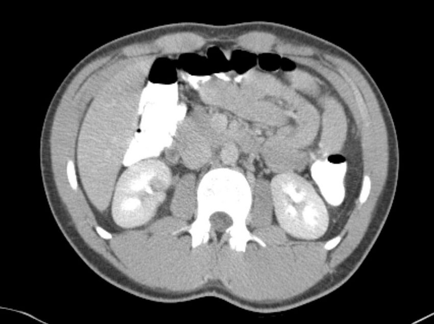 Appendicitis and incidental foregut duplication cyst (Radiopaedia 52962-58916 A 20).jpg